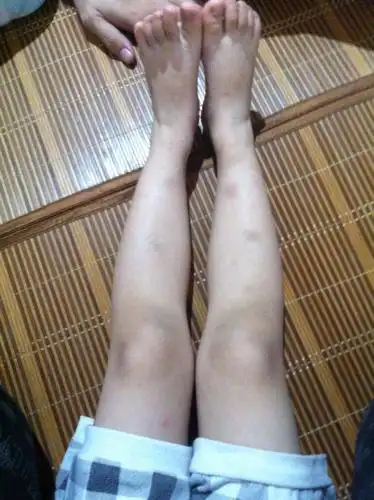 2014-03-23 李翠英 医师 在医院检查有o形腿,呈内八字!