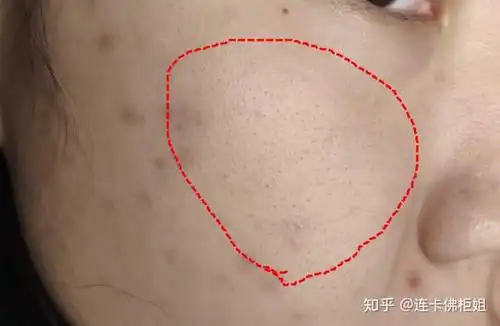 鼻子上和脸颊上黑头闭口粉刺多,怎么才能根除?