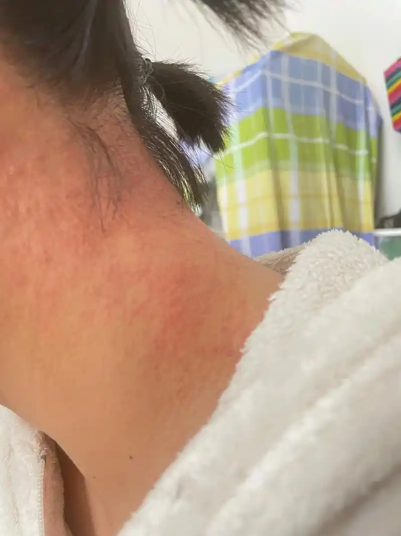 脖子红肿粗糙痒 好像是过敏性皮炎,上周明明好了,今天又开始了,痒的不