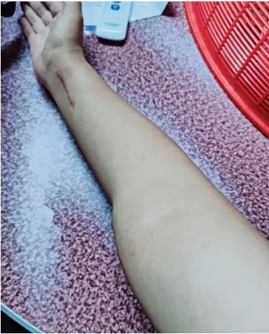 盼文的胳膊,博客文章,手臂骨折后的快速康复训练方法