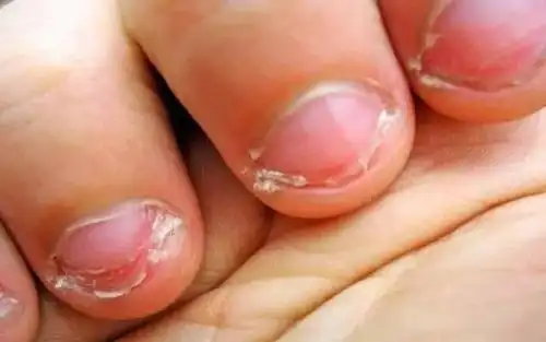 孩子吃手的危害竟然这么大!