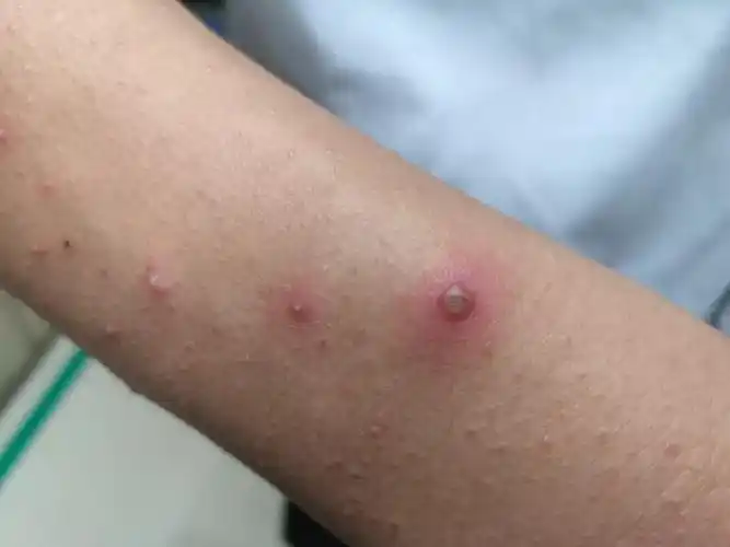 这么严重的湿疹,居然是您自身敏感引起的