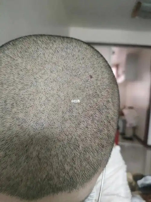 女生剃头发  宝宝们 这毛囊是多还是少还是正常啊