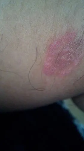 皮肤上出现这样的是怎么回事,大概有10天左右了,在快到大腿根部内侧处