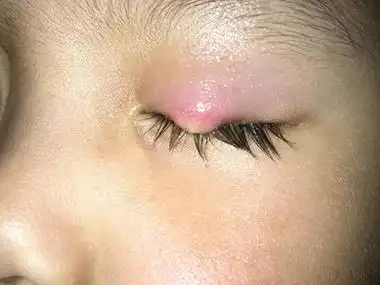 霰粒肿的症状和图片 - 有来医生