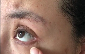 下睑下至程度过大,修复需沿原有疤痕处做切开,充分松懈粘连的下眼睑