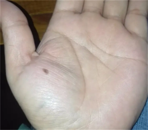 男人左手掌有痣好不好,男人左手掌有痣好不好图解_果仁网