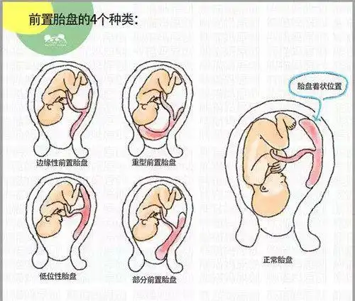 孕育科普:前置胎盘vs后置胎盘