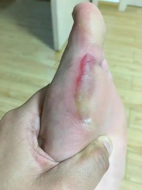 踢球,脚起泡了,是什么原因?怎么处理啊