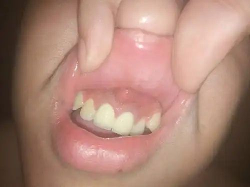 门牙牙龈长了一个小包,不痛,但是很难受不舒服