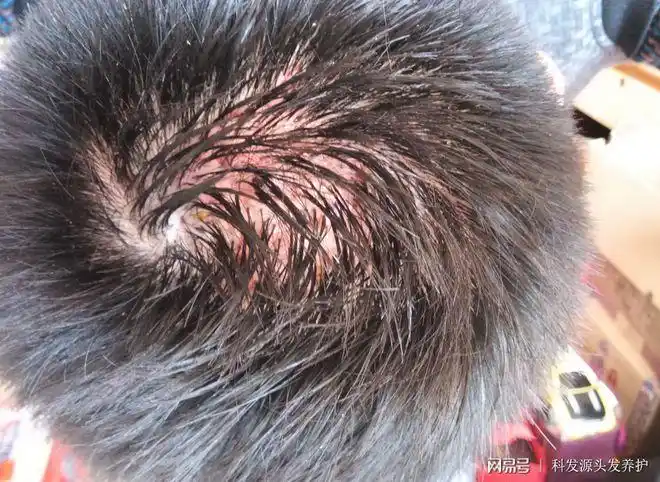 头发经常有红肿疙瘩是毛囊发炎了