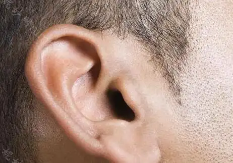 耳朵畸形6种常见图片照,每种治疗方案都不同_大全