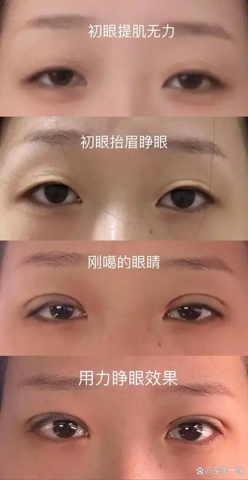 提肌无力噶双眼皮第一天