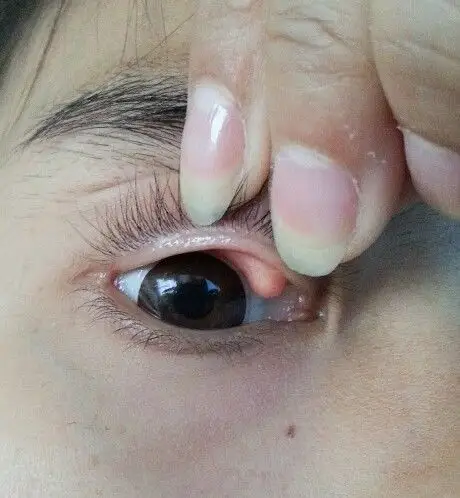 上眼睑长了个包,不痛不痒,也感觉不到,不把眼皮翻开也看不出来,不知道