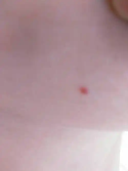 我双乳房各有一个小红点,不疼,其中一个较大的有几年了,另一个比较小.