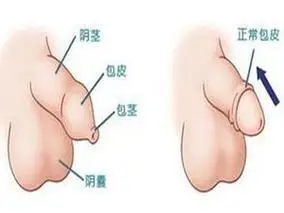 小儿包茎的病因有哪些?