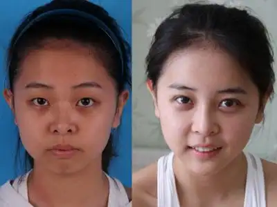 鼻翼宽,鼻头大就一定要切才能解决吗_福华医疗美容诊所(金贵香整形