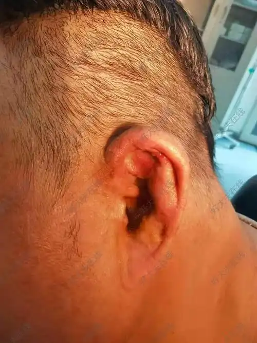 耳廓化脓性软骨膜炎_骨膜炎 - 好大夫在线