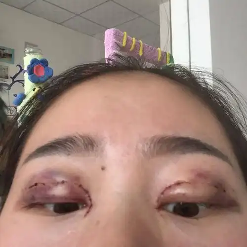 埋线双眼皮第四天,眼睛咋还是个这