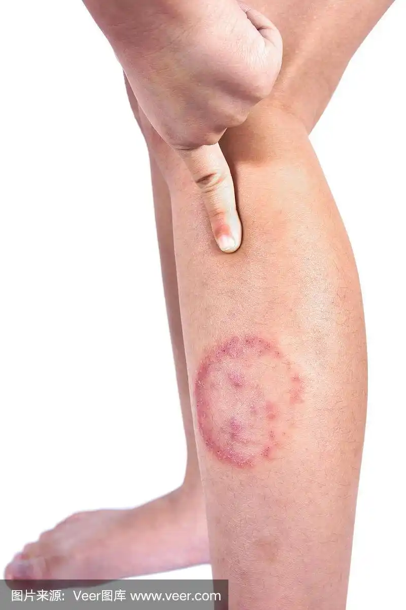 白色背景下分离的皮肤有癣或体癣,分离的皮肤有皮肤真菌病