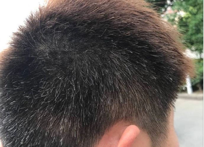 因为后脑勺所对应的反射区是膀胱经,膀胱经虚弱的患者常会伴随着尿频