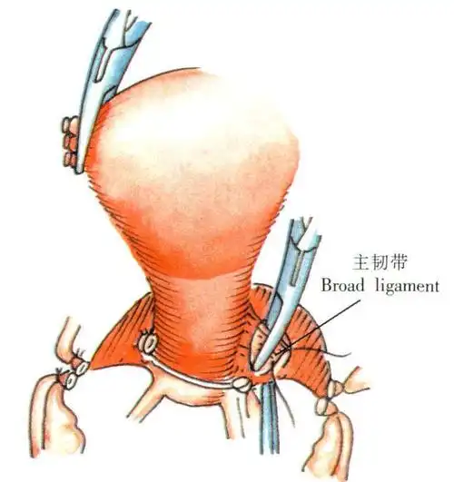 筋膜内全子宫切除术