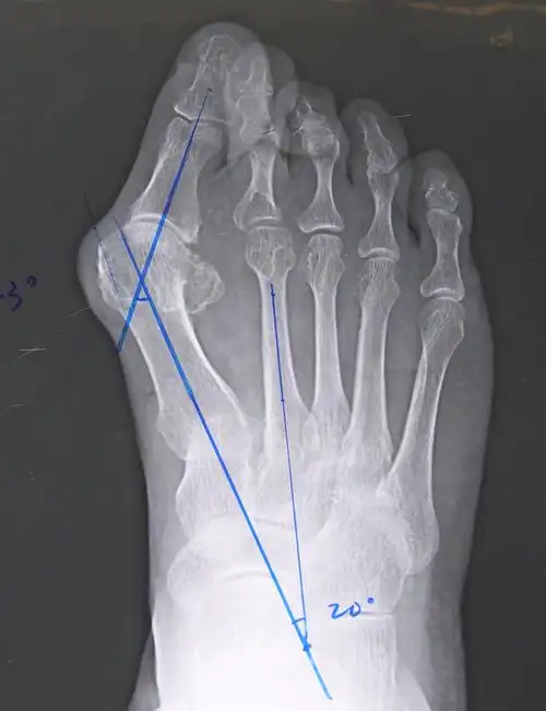 脚骨图片(18岁女孩和妈妈都是大脚骨) - 赤虎壹号