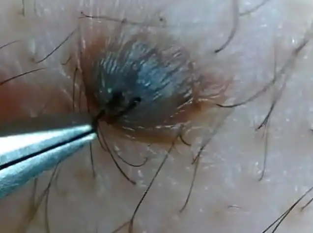 抓住突起痣毛用力撕扯 整根毛恶烂炸出 看了却有点爽_未解之谜网