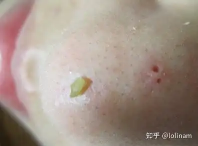 第一次挤出了黑头怎么样才能让它不再长出来