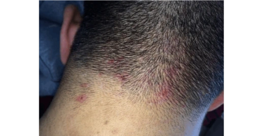 头上长痘痘怎么治疗,六个妙招解决痘痘烦恼