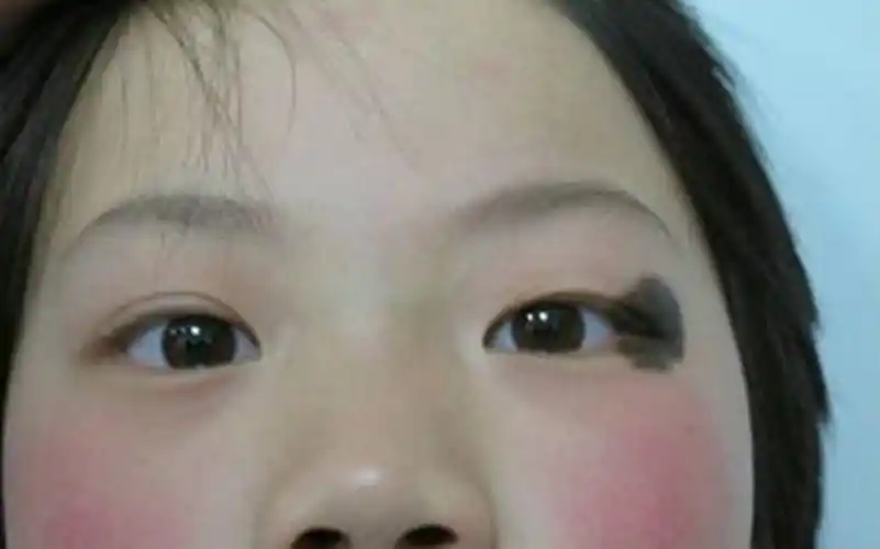 眼睑色素痣