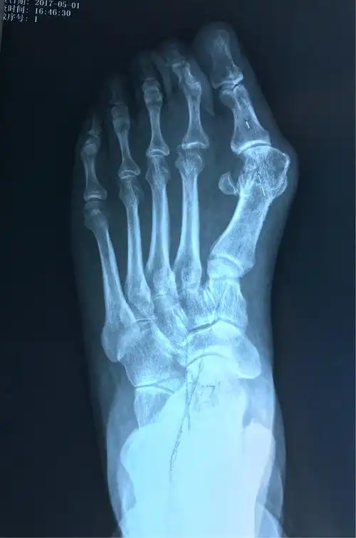 负重x线片观察:第一二跖骨间夹角增大明显,第二跖趾关节半脱位.