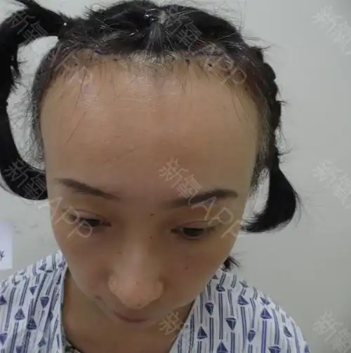 我感觉我的发际线后移还算可以并不是后移的很厉害的那_圈子-新氧美容
