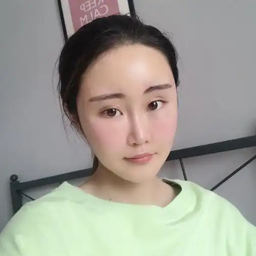 脸部脂肪填充多久恢复正常_脸部脂肪填充多久恢复正常肤色