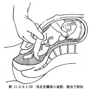 子宫底剖腹产术