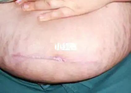 设计_腹肌_拉皮_妊娠_瘦肚子_腹壁成形术_美妆_医美整形