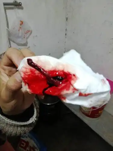 来月经,出现这样的正常么,最近药吃的多.而且筋刺痛