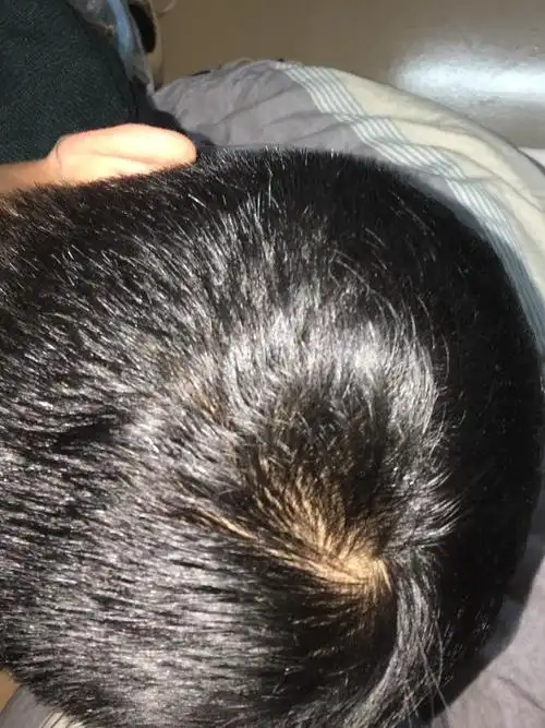 脱发了,头顶看见头皮了,持续应该已经有1年的时间,现在时常会出现