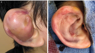 nejm耳廓血肿病例报道