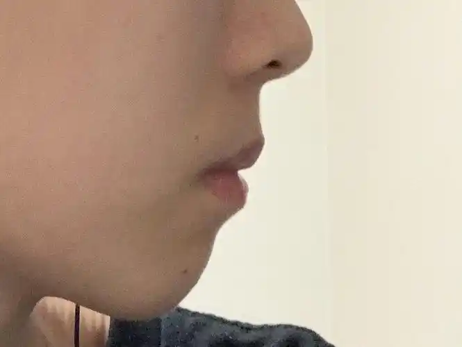 总感觉自己侧脸很怪很难看 有点想去带隐形牙套