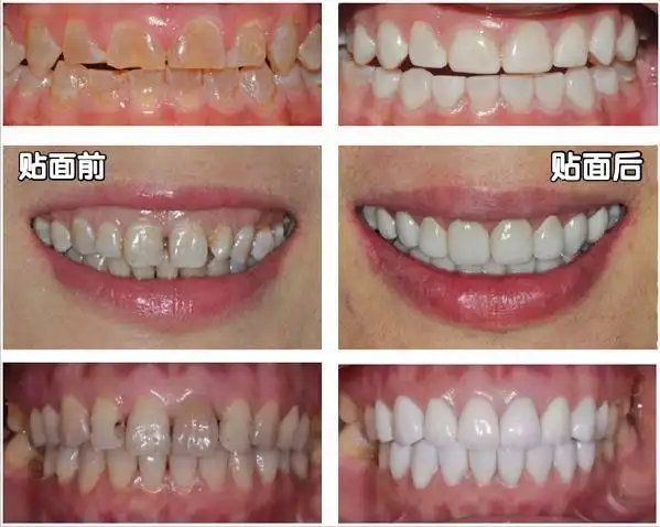 牙齿美白居然这么简单听听口腔专家怎么说