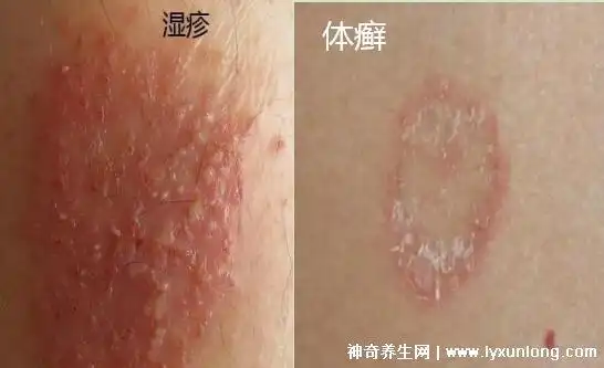 体癣图片初期症状图片圆形红斑边缘一圈红肿脱屑和湿疹区分