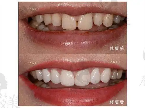 重庆牙齿美白哪家好?皓齿健口腔榜上有名!颜瓷贴面1980元起_荔枝美