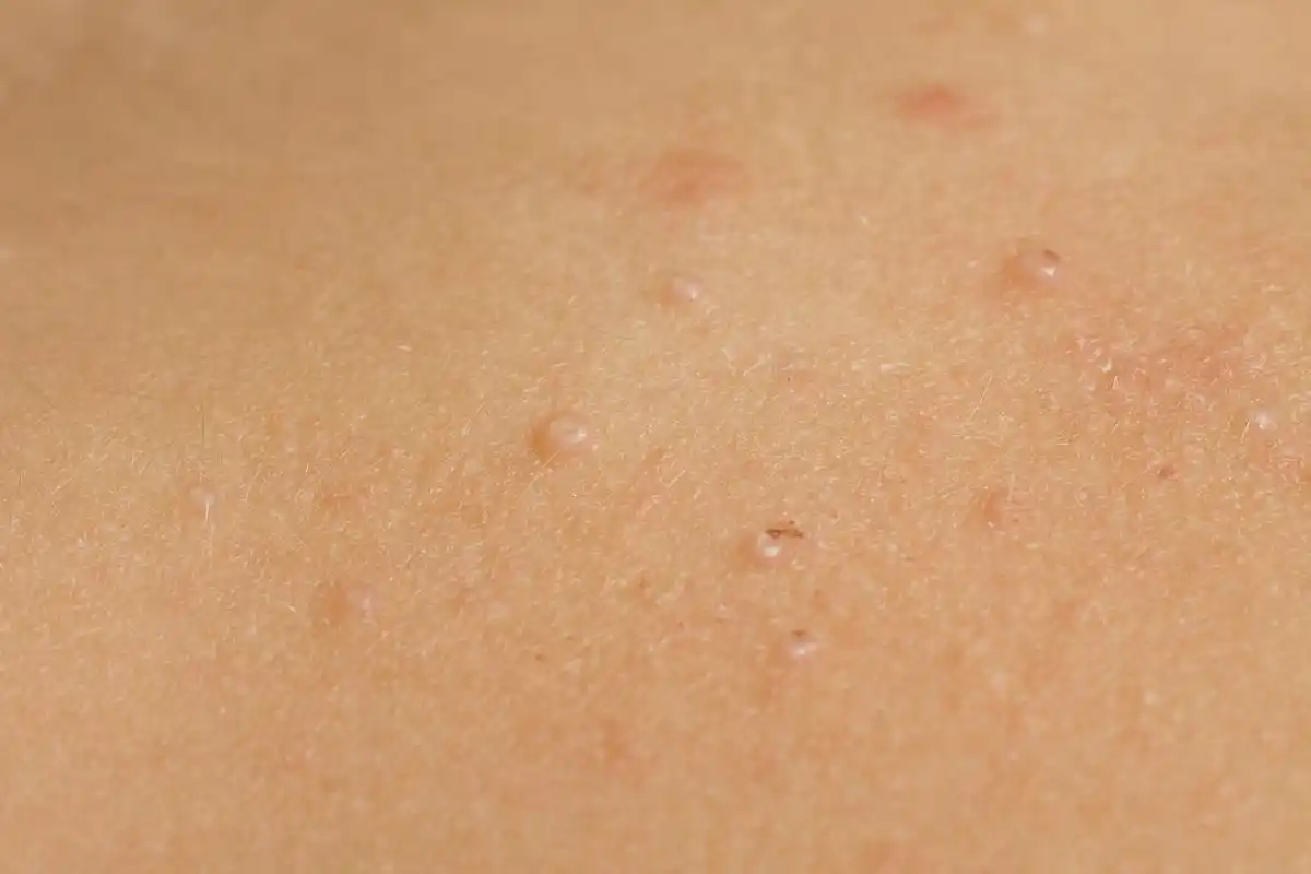 常见的5类皮肤癣! 体癣是一种常见的皮肤癣,通常发生在身体的不同部位