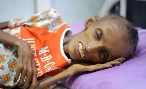 世界阴暗面瘦如皮包骨头的十八岁女孩只因为没有吃的