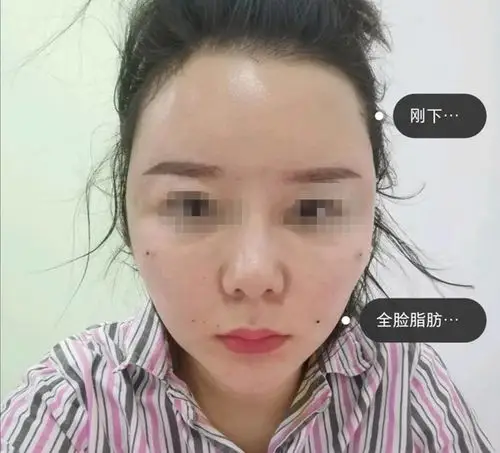 看看我脂肪填充30天恢复的照片解答各位做完脂肪填充多久可以消肿