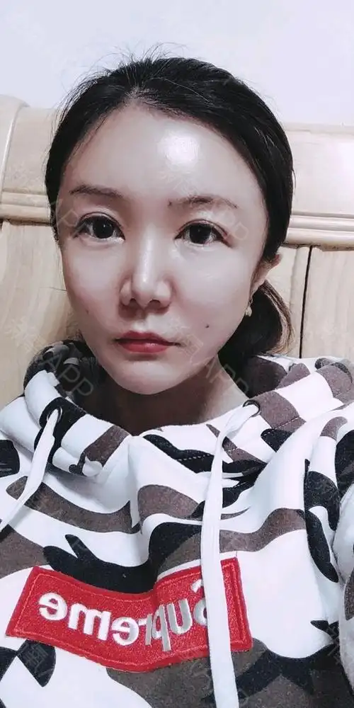 自体脂肪填充全脸