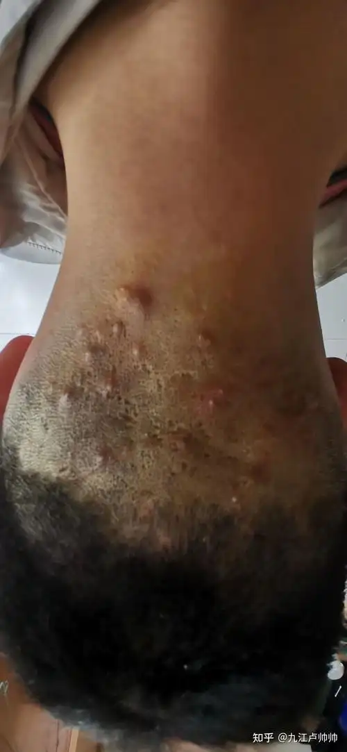 头皮毛囊炎的治疗之路! - 知乎