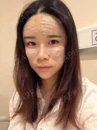 自体脂肪全脸填充好不好_效果图_婷美婷美自体脂肪全脸填充术后第8天