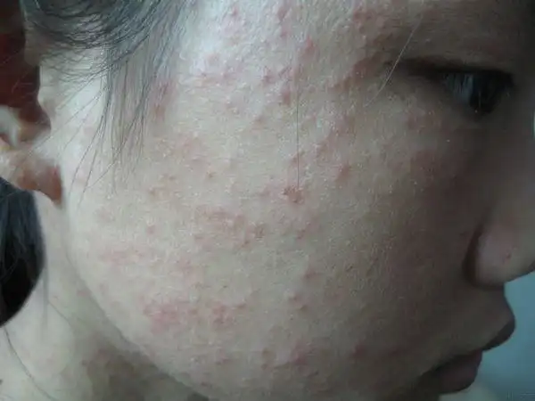 脸用祛痘的产品过敏了,刚开始是红痒,过了四天红消退了,皮肤上长了密